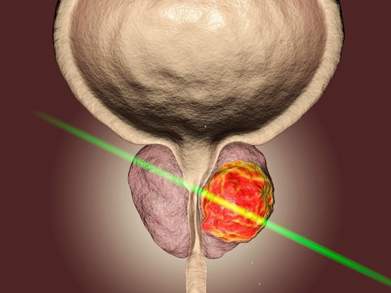Prostata aumentada PSA alterado e cancer de prostata entenda as diferencas